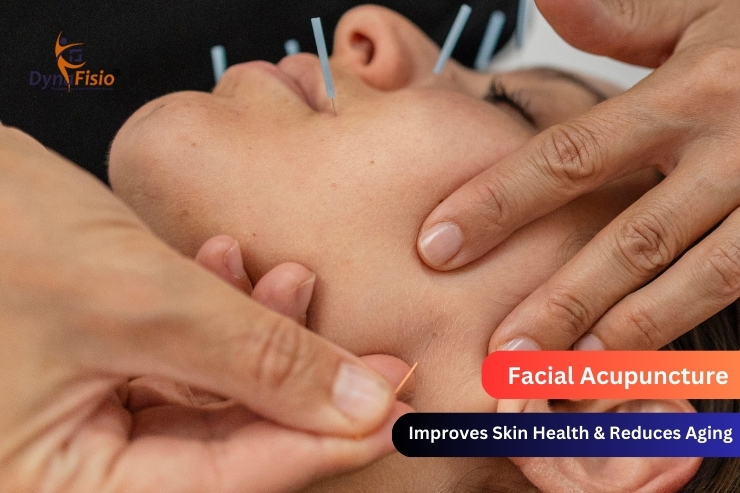 How Facial Acupuncture Improves Skin Health and Reduces Aging Signs