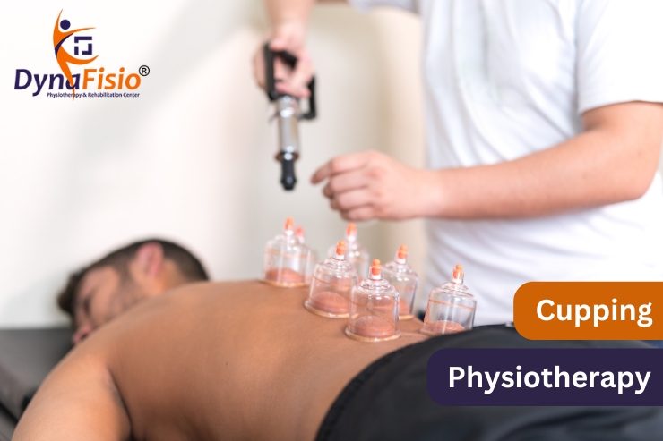 The Science Behind Cupping Physiotherapy and Its Benefits