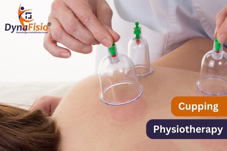 Understanding the Science Behind Cupping Therapy