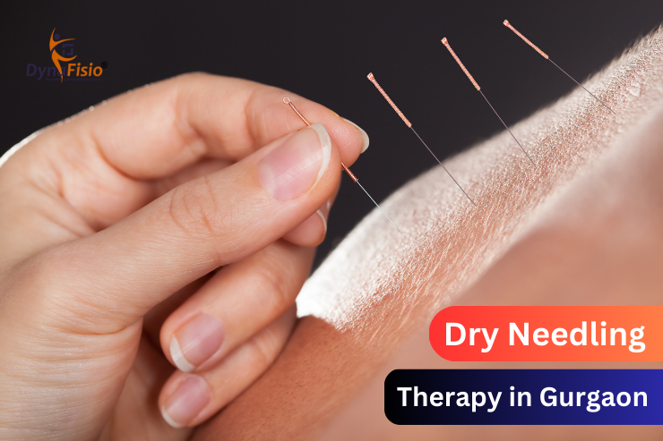 Top 10 Benefits of Dry Needling for Pain Relief