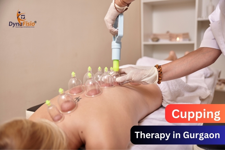Cupping Therapy for Athletes: Recovery, Performance, and More