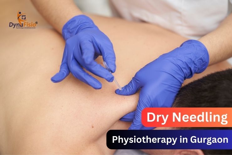How Dry Needling Eases Chronic Pain and Improves Mobility