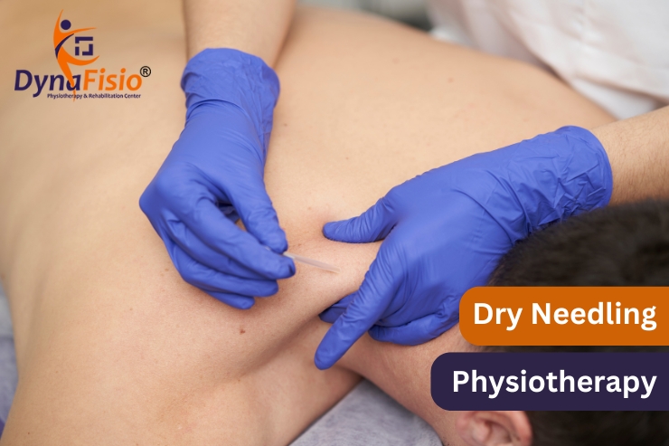 Understanding Dry Needling Physiotherapy: How It Works and Its Benefits