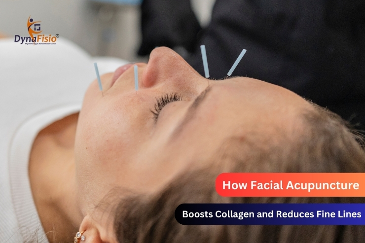 How Facial Acupuncture Boosts Collagen and Reduces Fine Lines