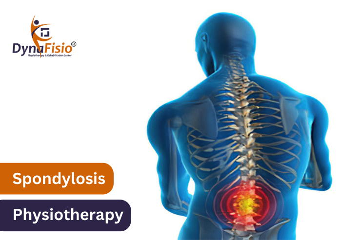 Unlocking The Potential Of Physiotherapy For Spondylosis Rehabilitation