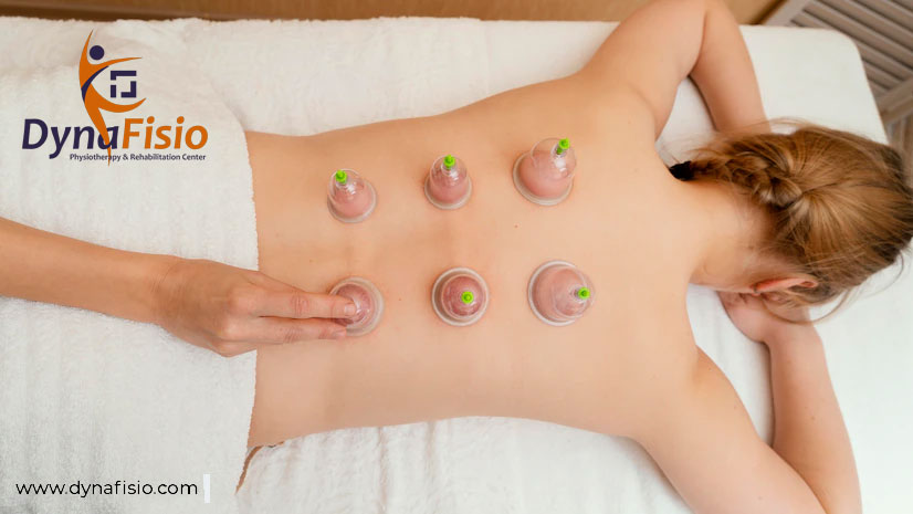 Cupping Therapy