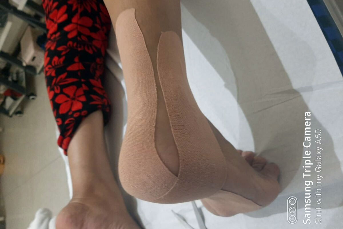 Kinesiology Taping at Dynafisio