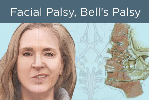 Facial Palsy Treatment in Gurgaon