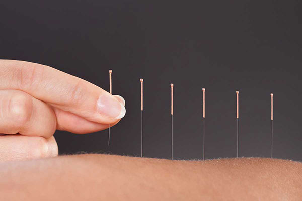  Dry Needling Therapy Treatment In Gurgaon