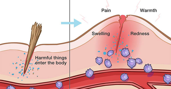 Inflammation Physiotherapy Treatment in Gurgaon